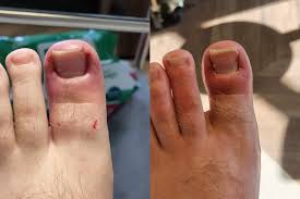 Image result for Toenail Removal
