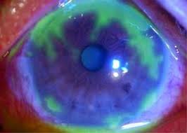 We did not find results for: Herpes Simplex Keratitis Wikem