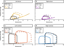 Image result for Delayed Transition from Fetal Circulation