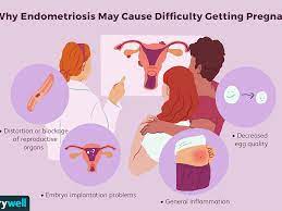 How To Get Pregnant When You Have Endometriosis