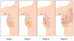 These summaries include detailed information about and pictures of diagnostic tests and procedures for each specific type of cancer. Understand Different Breast Cancer Stages To Determine A Proper Diagnosis And Treatment Breast Cancer