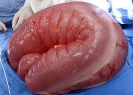 Image result for Megacolon