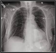 Image result for Transcutaneous Pacing