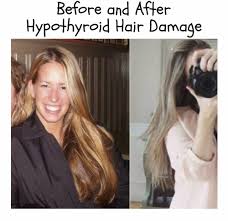 Hypothyroidism Hair Damage Postpartum Hair Loss Hair Loss Remedies Hair Loss Causes