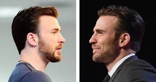 Chris Evans' Hair Transplant