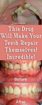 Inspect the tooth area and crown. This Drug Will Make Your Teeth Repair Themselves Incredible Health Beauty Teeth Beautyblogger Diy Health Health Diet Dental Fillings
