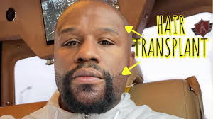 Male hormones are called androgens and they stimulate the growth of hair follicles on the face. Floyd Mayweather Gets Hair Transplant Beard Transplant From Turkey Youtube