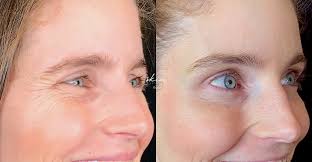 Before and After Cases: Botox® - Skin Boutique