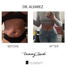 Sergio alvarez, md is a cosmetic, plastic & reconstructive surgery specialist in miami, fl. Mia Aesthetics Dr Alvarez Snatched Her Tummy Tummy Tuck By Dr Alvarez Tummytuck Dralvarez Facebook