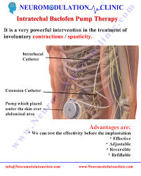 Image result for Intrathecal Pump