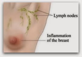 Inflammatory breast cancer (ibc) is one of the most aggressive forms of breast cancer. The Silent Killer Inflammatory Breast Cancer Pictures And Early Detection Youmemindbody