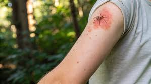 Image result for wolf spider bite skin