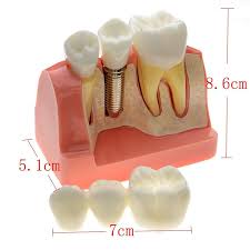 We did not find results for: Analisis Crown Bridge Demonstrasi Gigi Model Gigi Implan Dental Teeth Dental Crowncrown Dental Aliexpress