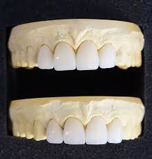 Temporary veneers, everyday veneers, affordable & convenient How Much Do Veneers Cost The Lowdown On Porcelain Veneers