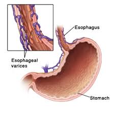 Arteries carry the blood away from the heart to respiring tissues at high pressure. Esophageal Varices