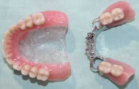 Browse 947 upper denture stock photos and images available, or start a new search to explore more stock photos and images. Partial Dentures Plates