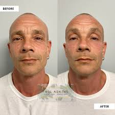 You say under eyes and I'll say Restylane! First time patient but I don't  think it will be his last! 🤩👀 ~~~~~~~ BOOK WITH ME ~~~~~~~ 703.361.3232  @vitanovamedspa #volbella #techneck #neckfiller #defyne #