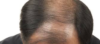 As per its name, superficial bcc is characterized by a flat, distinct area of discoloration, referred to as a macule. Skin Diseases Of The Scalp