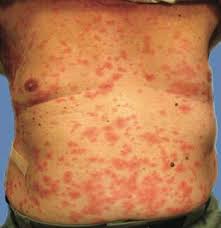 Image result for Generalized Rash