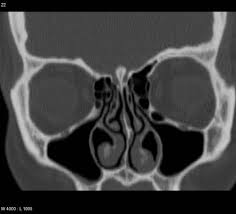 Concha bullosa and haller cell resection, maxillary sinus outflow obstruction. Haller Cells Radiology Reference Article Radiopaedia Org