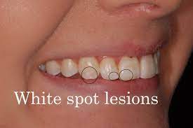So the combination of baking soda and hydrogen peroxide works well to remove white spots from teeth. White Spots Teeth What Are They And How Do You Get Rid Of Them