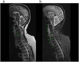 Image result for Spinal Infection