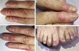 Image result for Chilblains