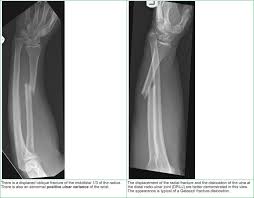 Image result for Galeazzi Sign