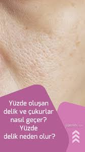 Yuzde Olusan Delik Ve Cukurlar Nasil Gecer Yuzde Delik Neden Olur Sivilce Izi Yuzler Genetik