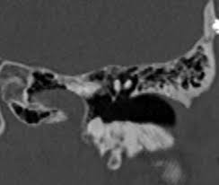 Image result for Ossicular Chain Disruption