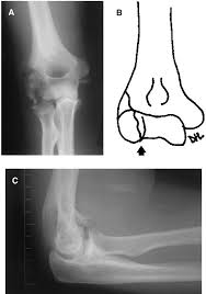 Image result for Lateral Condyle Fracture