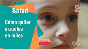 Como Quitar Los Orzuelos En Los Ninos Salud Youtube