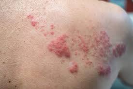 Chilblains causes the skin on your toes, other parts of your feet, fingers, or other affected areas to burn and itch. The Covid 19 Vaccine Won T Give You Herpes Here S Why