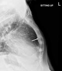 Image result for Sternal Fracture