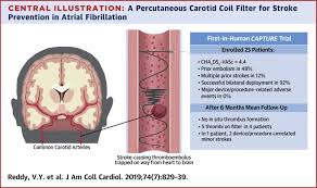 Check spelling or type a new query. Permanent Percutaneous Carotid Artery Filter To Prevent Stroke In Atrial Fibrillation Patients The Capture Trial Sciencedirect