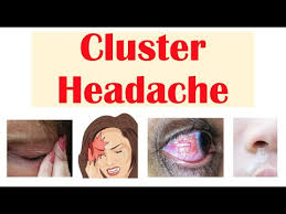 Image result for Cluster Headache