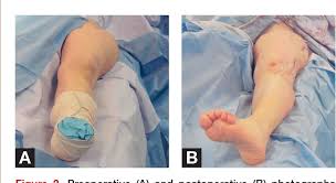 Image result for Femoral Retroversion