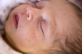 Both hsv i and hsv ii can cause disease on the mouth or genitals. Baby Acne Causes Diagnosis And Treatment