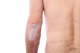 A psoríase melhora e piora espontaneamente e pode ter remissões periódicas (pele clara). Psoriase Dermatologista Porto Alegre Dra Juliana Fonte