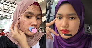 Begini cara menghilangkan jerawat secara alami, beserta bekasnya. Be Smart People Gadis Dedah Cara Hilangkan Masalah Jerawat Dengan Hanya Rm5 Wow