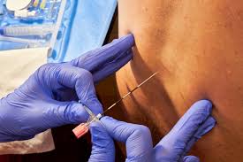 Image result for Active Labor Anesthesia