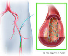 Maybe you would like to learn more about one of these? Carotid Artery Disease