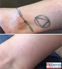 Laser tattoo removal works by targeting ink pigments below your skin and breaking them down into even smaller particles, which are then absorbed by your your body responds with inflammation, and that's how the blisters come to be. Tattoo Pain Vs Laser Tattoo Removal Pain Medermis Laser Clinic