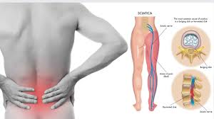 The gluteus maximus is one of the most important muscles in the body, and keeping it strong can help support the lower back. 8 Sciatica Stretches To Help Prevent And Relieve Hip And Lower Back Pain