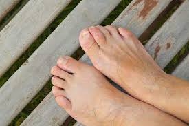 Tapi kalau gatal itu terjadi di telapak kaki, mungkin kamu akan berpikir ulang. Paronikia Gejala Penyebab Dan Mengobati Alodokter