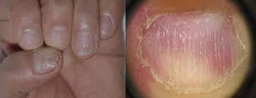 Health checks, expert tips & advice, online wellness. Pathogenesis Clinical Signs And Treatment Recommendations In Brittle Nails A Review Springerlink