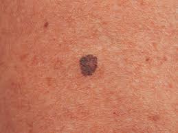 Other melanoma warning signs may include: Skin Cancer Deaths Rise 150 Per Cent Since 1970s The Signs You Need To Know
