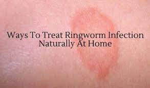 Ways To Treat Ringworm Infection Naturally At Home Ringworm Ringworm On Skin Fungal Infection Skin