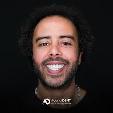AcunalDent