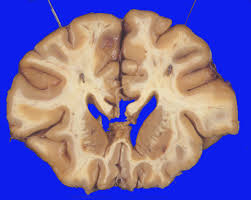 Image result for Pallidotomy